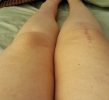 [Bonesmart.org] Lovetocookandsew’s long road to recovery