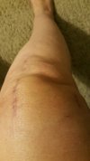 [Bonesmart.org] Lovetocookandsew’s long road to recovery