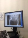 [Bonesmart.org] Miss Muffet proudly presents - her new hips