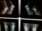 [Bonesmart.org] 4 years out please help