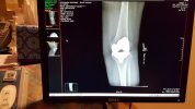 [Bonesmart.org] Freedom works on recovery<<