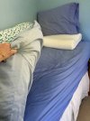 [Bonesmart.org] 6 months post-op, still can’t walk unaided without limp'