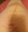 [Bonesmart.org] CaliGirl's post op journey.