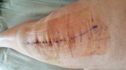 [Bonesmart.org] Lovetocookandsew’s long road to recovery