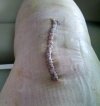 [Bonesmart.org] This Teacher's TKR Recovery Journey