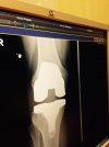 [Bonesmart.org] CATSMUM's new road to recovery