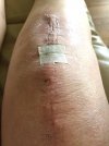 [Bonesmart.org] Suz's Recovery Journey