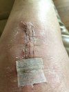[Bonesmart.org] Suz's Recovery Journey