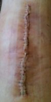 [Bonesmart.org] No Kneecap and a TKR Experience