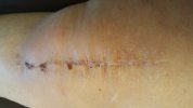 [Bonesmart.org] Lovetocookandsew’s long road to recovery