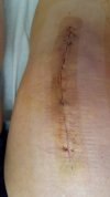 [Bonesmart.org] Freedom's right knee<
