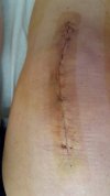 [Bonesmart.org] Freedom's right knee<