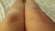 [Bonesmart.org] Lovetocookandsew’s long road to recovery
