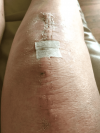 [Bonesmart.org] Suz's Recovery Journey