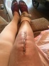 [Bonesmart.org] Suz's Recovery Journey