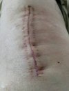 [Bonesmart.org] This Teacher's TKR Recovery Journey