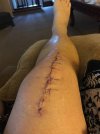 [Bonesmart.org] Papas new knee<