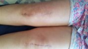 [Bonesmart.org] Freedom's right knee<