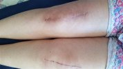 [Bonesmart.org] Freedom's right knee<