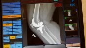 [Bonesmart.org] Freedom's right knee<