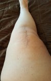 [Bonesmart.org] Lovetocookandsew’s long road to recovery