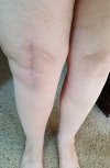 [Bonesmart.org] Lovetocookandsew’s long road to recovery