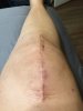 [Bonesmart.org] Clara welcomes her new knee!!!