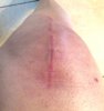[Bonesmart.org] Clara welcomes her new knee!!!
