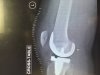 [Bonesmart.org] Nana Moon's Shiny New Second Knee
