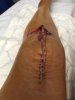 [Bonesmart.org] Nana Moon's Shiny New Second Knee