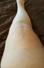 [Bonesmart.org] One Year Update: problems cycling