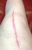 [Bonesmart.org] Bruising 3 years out