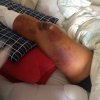 [Bonesmart.org] Anemic after TKR ..exhausted