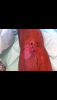[Bonesmart.org] Anemic after TKR ..exhausted