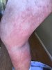 [Bonesmart.org] Hello from new member 8 weeks post op, persistent rash