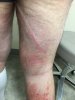[Bonesmart.org] Hello from new member 8 weeks post op, persistent rash