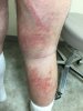 [Bonesmart.org] Hello from new member 8 weeks post op, persistent rash