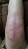 [Bonesmart.org] No Kneecap and a TKR Experience