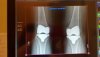 [Bonesmart.org] Freedom's right knee<