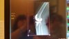 [Bonesmart.org] Freedom's right knee<
