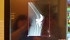 [Bonesmart.org] Freedom's right knee<
