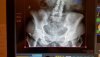 [Bonesmart.org] Freedom's right knee<