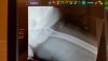 [Bonesmart.org] Freedom's right knee<