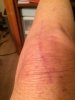 [Bonesmart.org] Diane's KneeQuest,  NewKnee Inn Recovery
