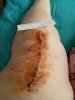 [Bonesmart.org] The girl with the two fake knees