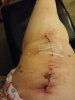 [Bonesmart.org] The girl with the two fake knees