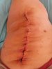 [Bonesmart.org] The girl with the two fake knees