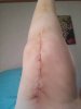 [Bonesmart.org] The girl with the two fake knees