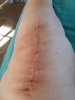[Bonesmart.org] The girl with the two fake knees