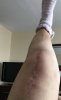 [Bonesmart.org] The girl with the two fake knees